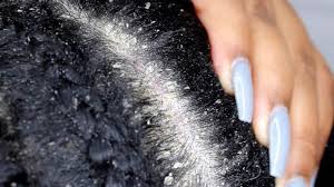 How to Get Rid of Lice (Home Remedies)